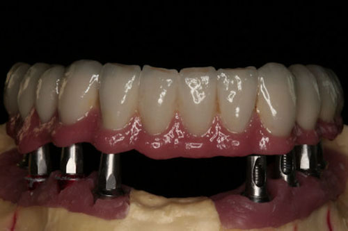 protesis fija Circonio