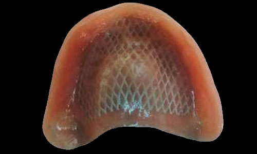 Prótesis total con malla